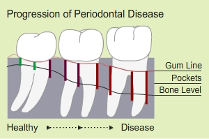 periodontal gum disease